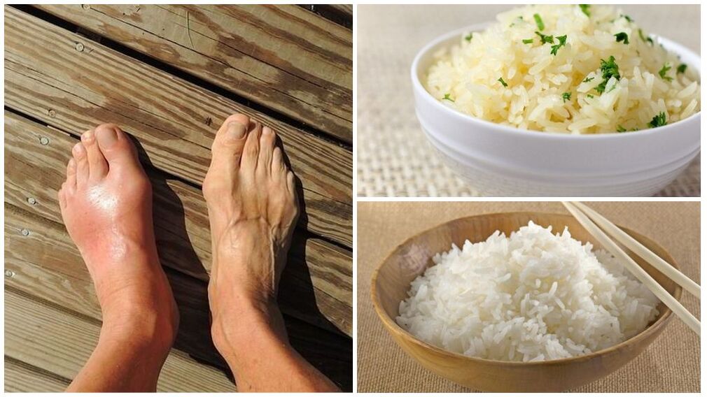 En risbaseret diæt anbefales til gigtpatienter. 